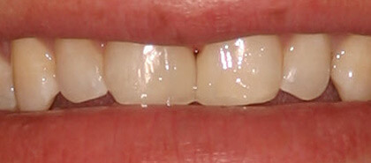 Dental Bonding – After | Cosmetic, Preventive, Restorative Dentist in Tucson