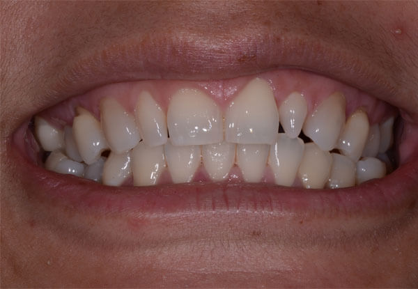 Dental Treatments – Before | Cosmetic, Preventive, Restorative Dentist in Tucson